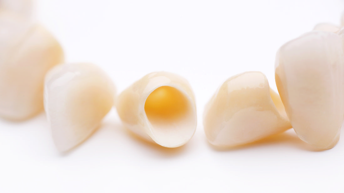Dental Crowns Somerset KY Blog CEREC V.S. Traditional Crowns