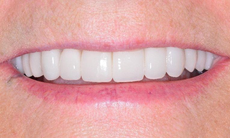 patient with full smile makeover