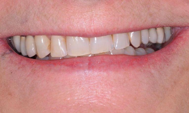 patient that needs smile makeover