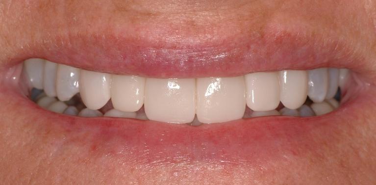 Cerec-Crowns-After-Image