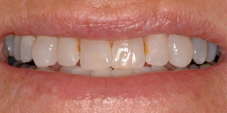 Cerec-Crowns-Before-Image