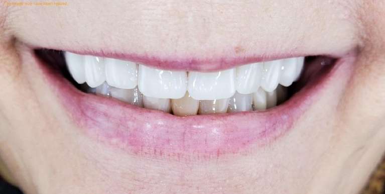 Upper-Denture-After-Image