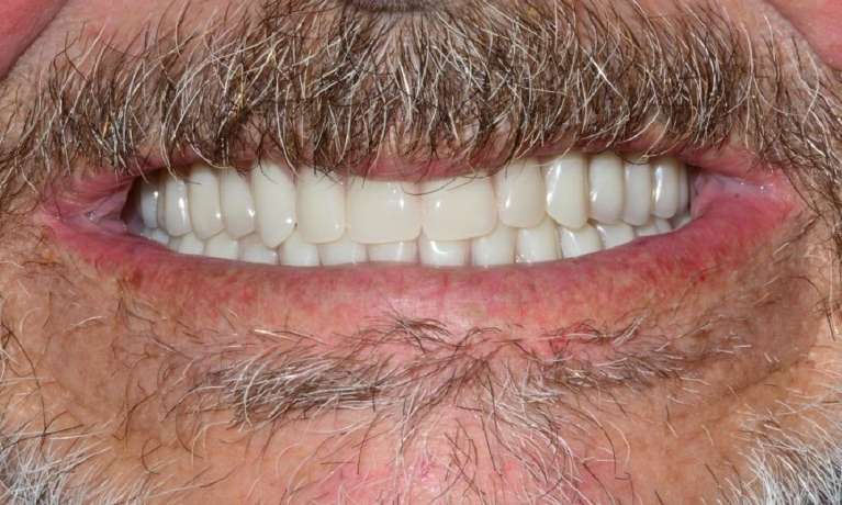 Upper-Denture-After-Image