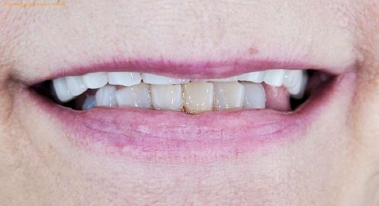 Upper-Denture-Before-Image