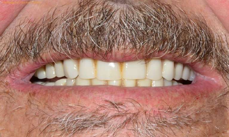 Upper-Denture-Before-Image
